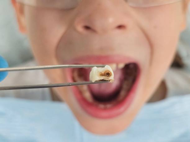 Best Emergency Tooth Extraction in Hauppauge, NY